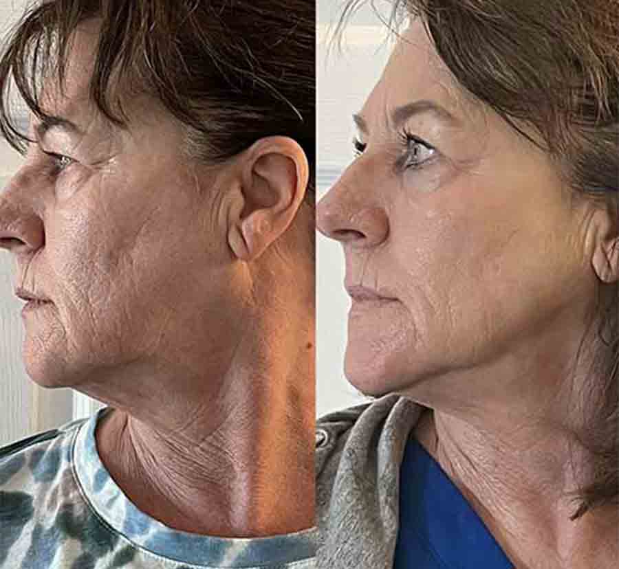 Before & After photos of CryoFacials in Northridge, Los Angeles, CA