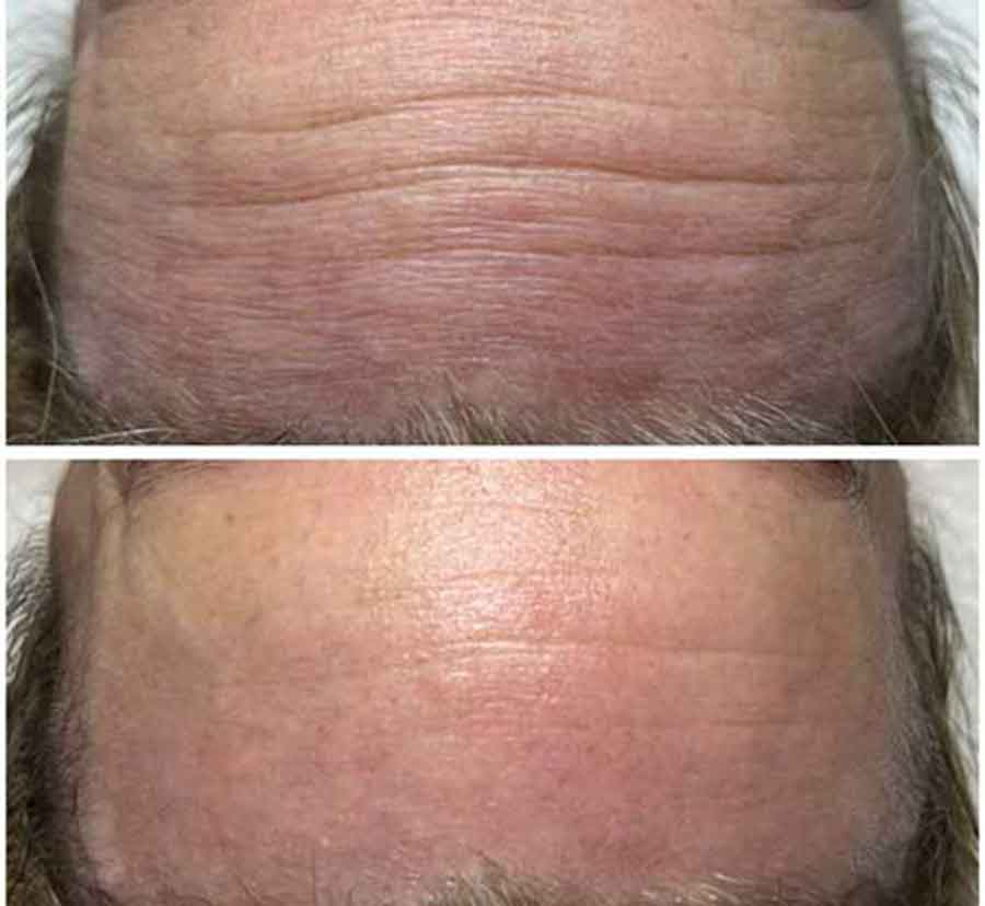 Before & After photos of CryoFacials in Northridge, Los Angeles, CA