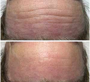 Before & After photos of CryoFacials in Northridge, Los Angeles, CA