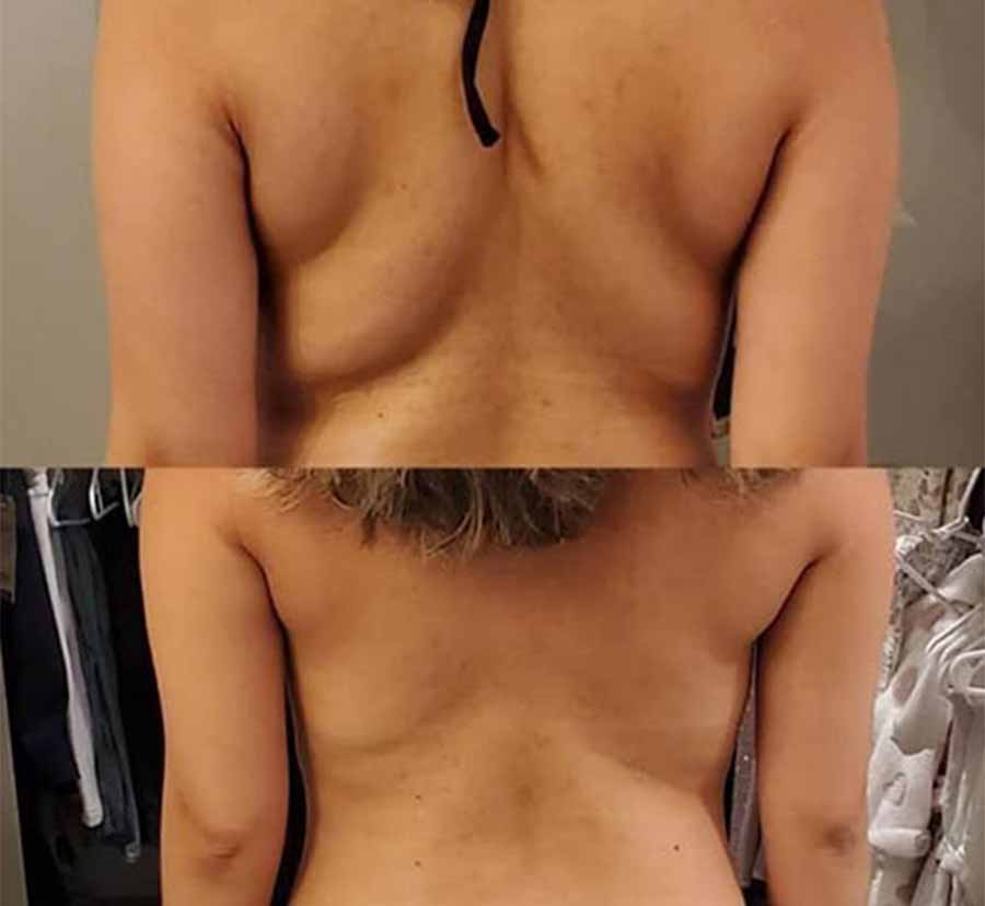 Before & After Photos of CryoSlimming in Northridge, Los Angeles, CA