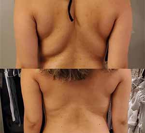 Before & After Photos of CryoSlimming in Northridge, Los Angeles, CA