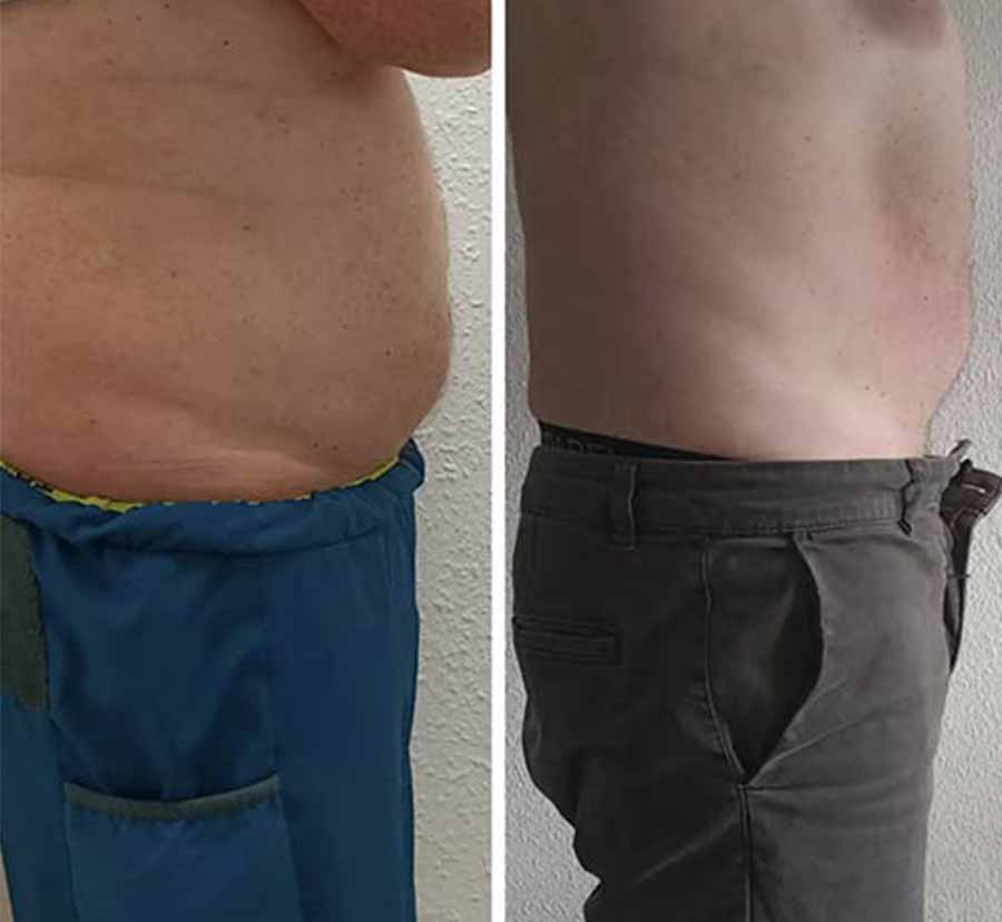 Before & After Photos of CryoSlimming in Northridge, Los Angeles, CA