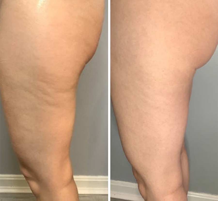 Before & After Photos of CryoToning in Northridge, Los Angeles, CA