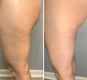 Before & After Photos of CryoToning in Northridge, Los Angeles, CA