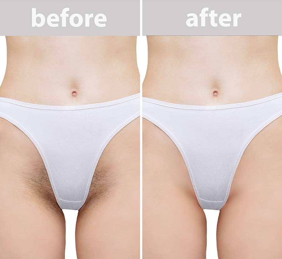Before & After photos of Laser Hair Removal in Northridge, Los Angeles, CA