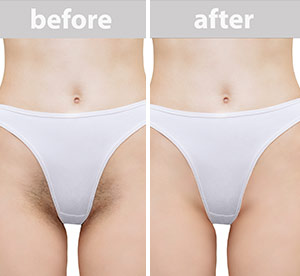 Before & After photos of Laser Hair Removal in Northridge, Los Angeles, CA