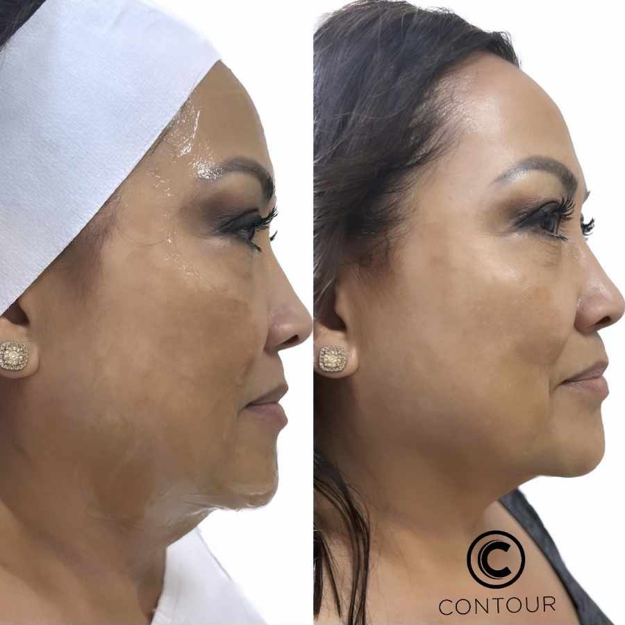 Before & After photos of CryoFacials in Northridge, Los Angeles, CA