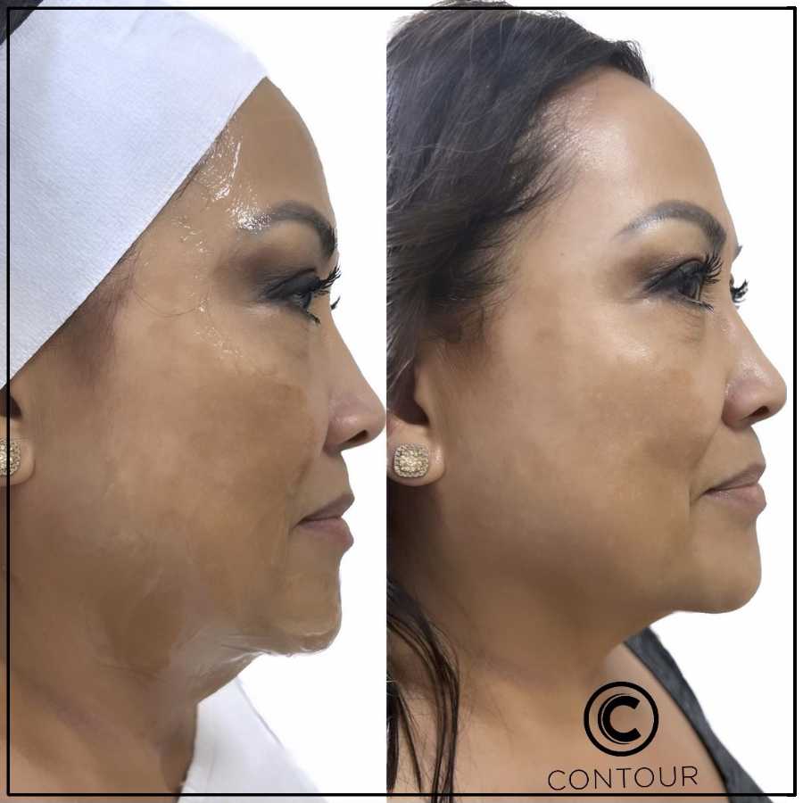 Cryo Facial Before and After in Northridge, Los Angeles, CA