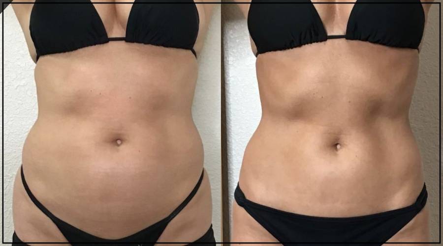 Before & After Photos of CryoSlimming in Northridge, Los Angeles, CA