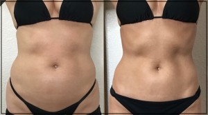 Cryoslimming Before and After in Northridge, Los Angeles, CA