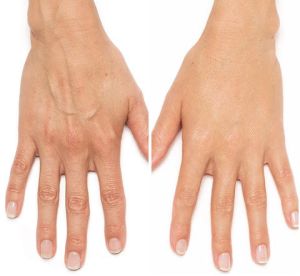 Before & After photos of Hands Rejuvenation in Northridge, Los Angeles, CA