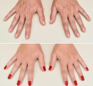 Before & After photos of Hands Rejuvenation in Northridge, Los Angeles, CA