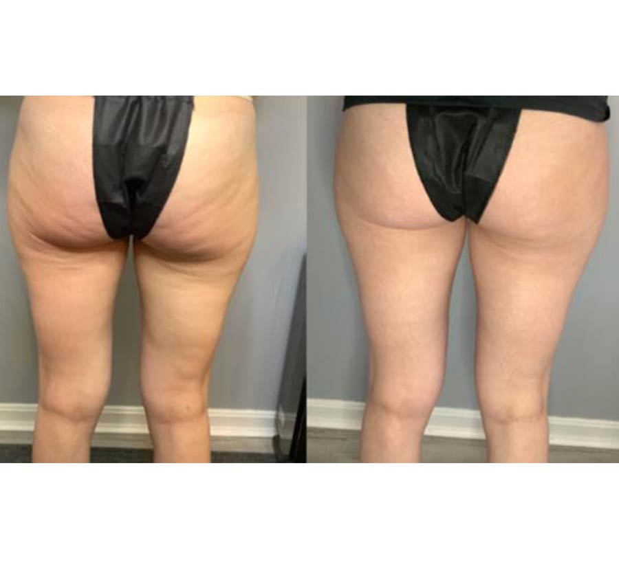 Before & After Photos of CryoToning in Northridge, Los Angeles, CA