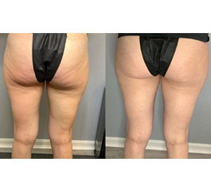 Before & After Photos of CryoToning in Northridge, Los Angeles, CA