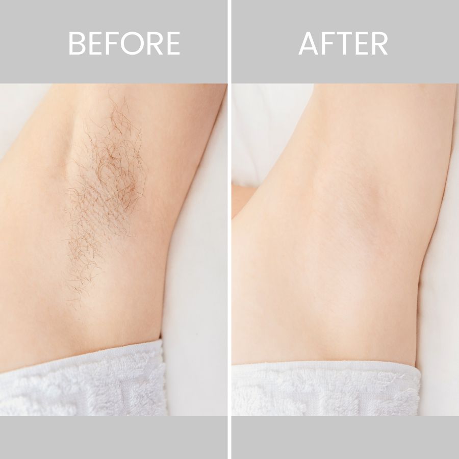 Before & After photos of Laser Hair Removal in Northridge, Los Angeles, CA
