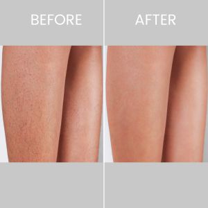Before & After photos of Laser Hair Removal in Northridge, Los Angeles, CA