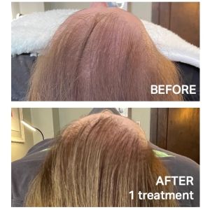Before & After photos of Keravive Hair Restoration by Hydrafacial in Northridge, Los Angeles, CA