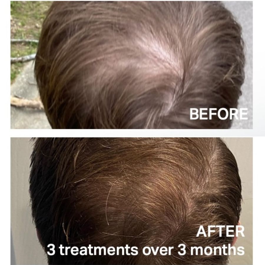 Before & After photos of Keravive Hair Restoration by Hydrafacial in Northridge, Los Angeles, CA