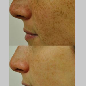 Before & After photos of Limelight IPL (PhotoFacial) in Northridge, Los Angeles, CA