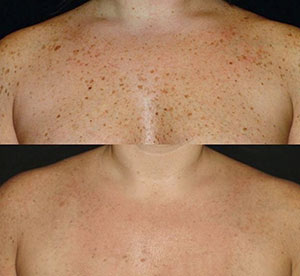 Before & After photos of Limelight IPL (PhotoFacial) in Northridge, Los Angeles, CA