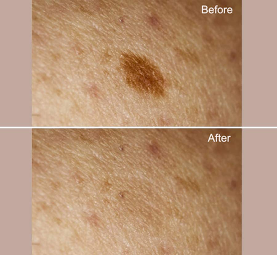 Before & After photos of Limelight IPL (PhotoFacial) in Northridge, Los Angeles, CA