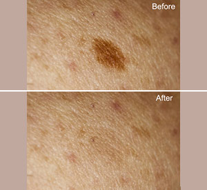 Before & After photos of Limelight IPL (PhotoFacial) in Northridge, Los Angeles, CA