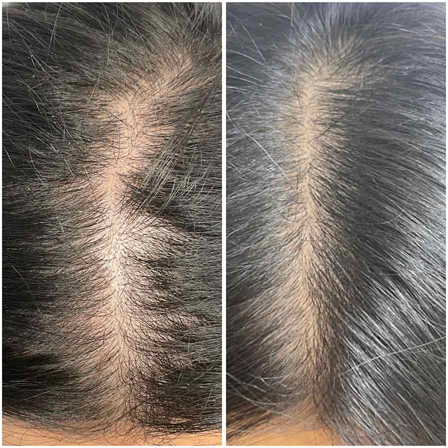Before & After photos of Keravive Hair Restoration by Hydrafacial in Northridge, Los Angeles, CA