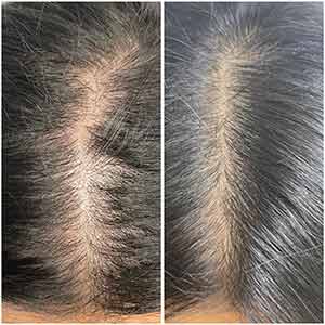 Before & After photos of Keravive Hair Restoration by Hydrafacial in Northridge, Los Angeles, CA