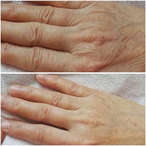 Before & After photos of Hands Rejuvenation in Northridge, Los Angeles, CA