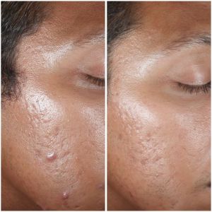 Before & After photos of Laser Peels Specialist Near Me in Northridge, Los Angeles, CA