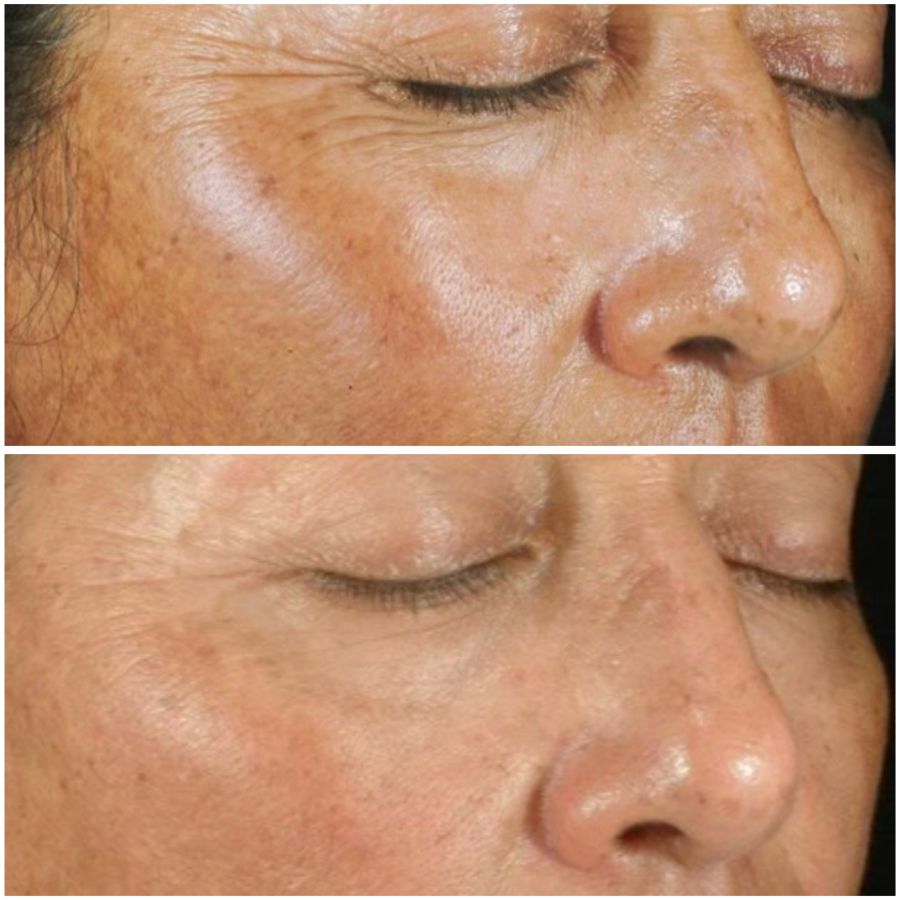 Before & After photos of Laser Peels Specialist Near Me in Northridge, Los Angeles, CA