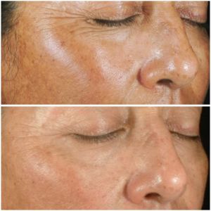 Before & After photos of Laser Peels Specialist Near Me in Northridge, Los Angeles, CA