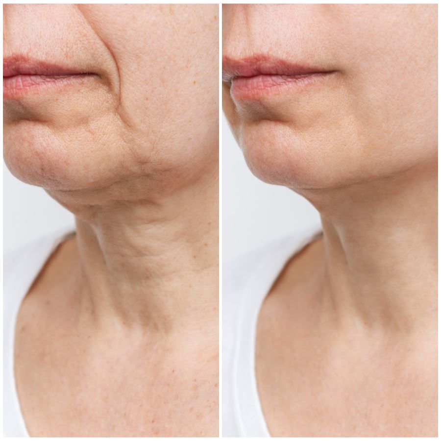 Before & After photos of Hands Rejuvenation in Northridge, Los Angeles, CA