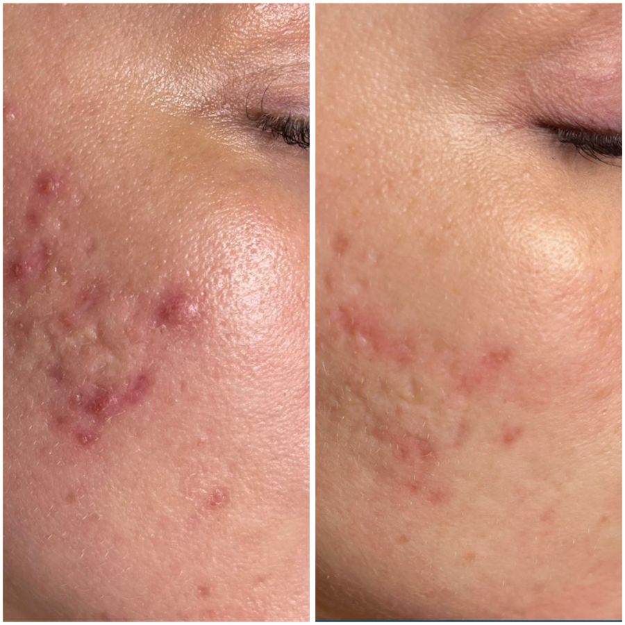 Before & After photos of Hands Rejuvenation in Northridge, Los Angeles, CA