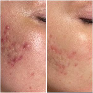 Before & After photos of Hands Rejuvenation in Northridge, Los Angeles, CA