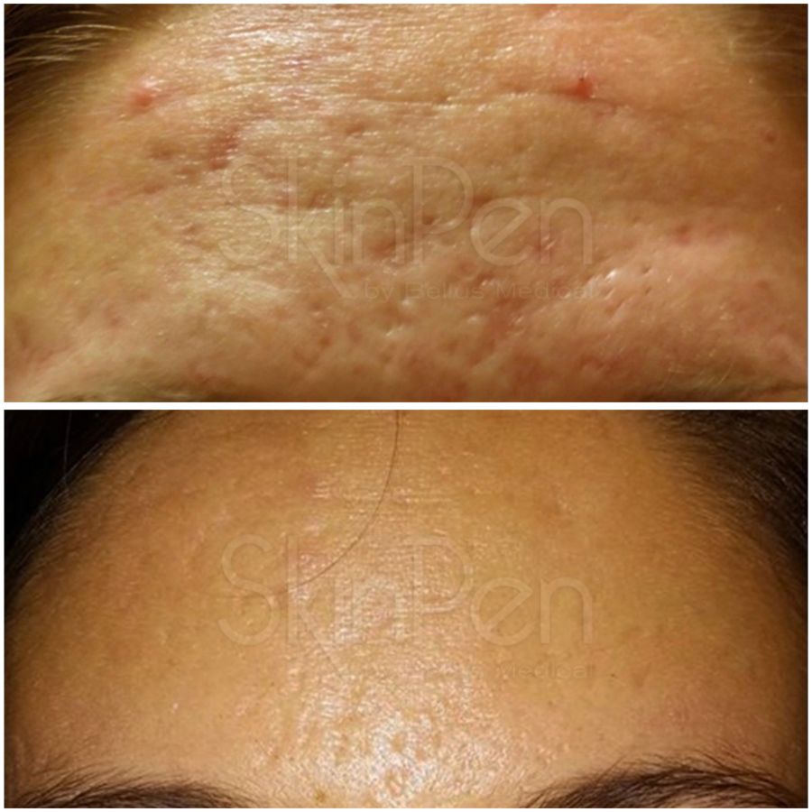 Before & After photos of Hands Rejuvenation in Northridge, Los Angeles, CA