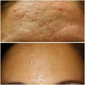 Before & After photos of Hands Rejuvenation in Northridge, Los Angeles, CA