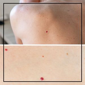 Cherry Angiomas in Northridge, Los Angeles, CA