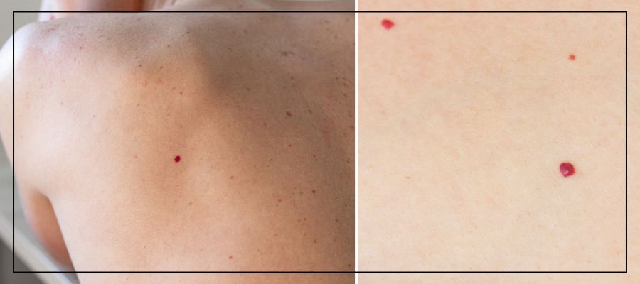 Cherry Angiomas Treatment Specialist Near Me in Northridge, Los Angeles, CA