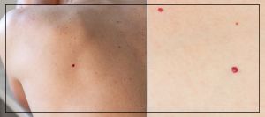 Cherry Angiomas Treatment Specialist Near Me in Northridge, Los Angeles, CA