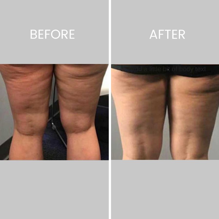 Before & After Photos of CryoToning in Northridge, Los Angeles, CA