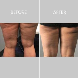 Cryotoning Specialist Near Me in Northridge, Los Angeles, CA