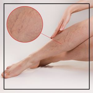 Spider Veins in Northridge, Los Angeles, CA