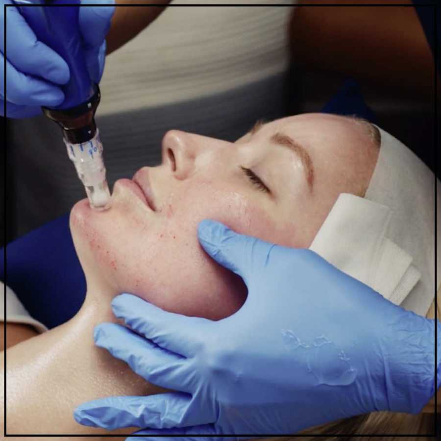 SkinPen Microneedling Treatment Specialist in Northridge, Los Angeles, CA SkinPen Microneedling Treatment Specialist in Northridge, Los Angeles, CA