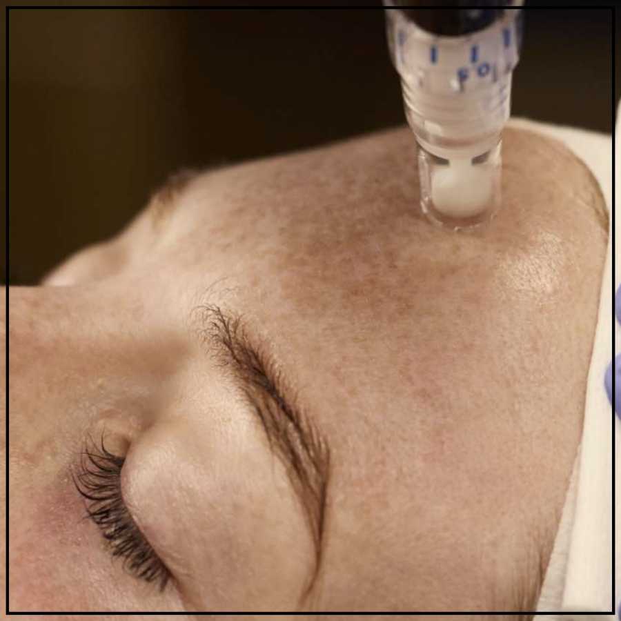 SkinPen Microneedling Treatment Specialist in Northridge, Los Angeles, CA SkinPen Microneedling Treatment Specialist in Northridge, Los Angeles, CA
