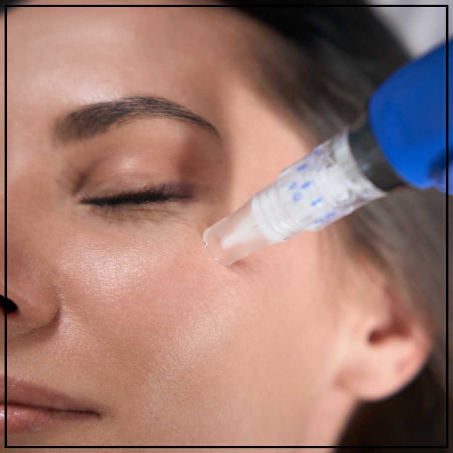 SkinPen Microneedling Treatment Specialist in Northridge, Los Angeles, CA SkinPen Microneedling Treatment Specialist in Northridge, Los Angeles, CA