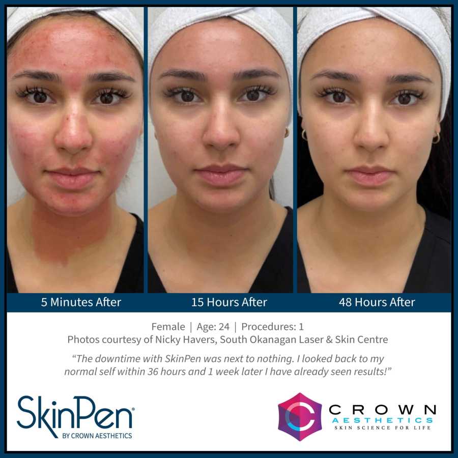 SkinPen Microneedling Treatment Specialist in Northridge, Los Angeles, CA SkinPen Microneedling Treatment Specialist in Northridge, Los Angeles, CA