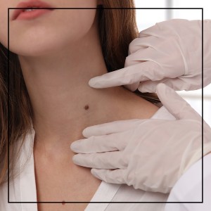 Laser Skin Tag Removal in Northridge, Los Angeles, CA