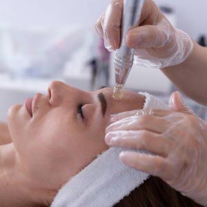 SkinPen Microneedling Specialist in Northridge, Los Angeles, CA
