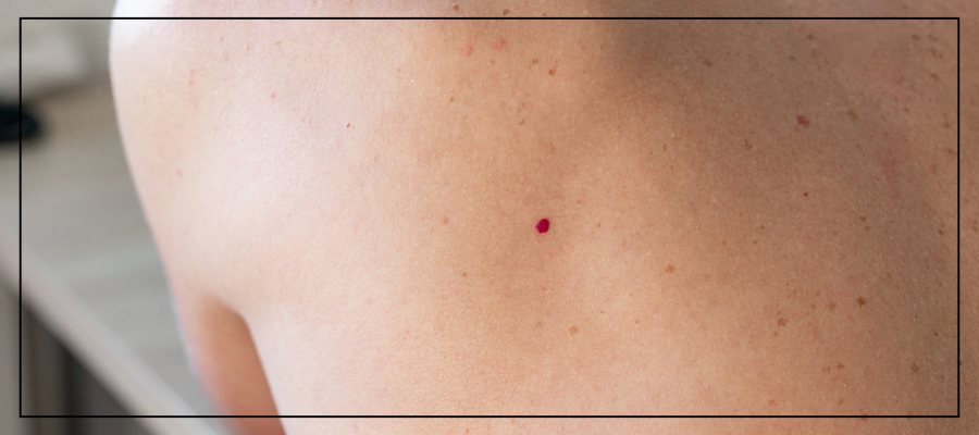 Cherry Angioma Removal Treatment Near Me In Northridge, Los Angeles, CA Cherry Angioma Removal Treatment Near Me In Northridge, Los Angeles, CA